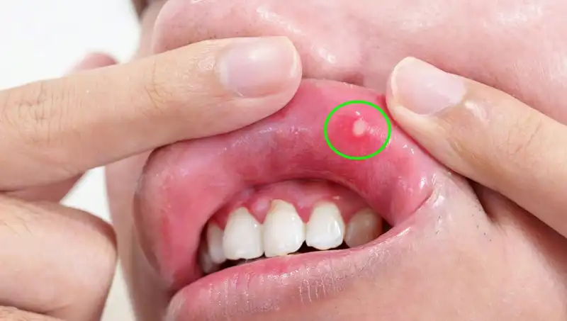 B Vitamini Eksikliği: Belirtileri ve Vücudunuz Üzerindeki Etkileri